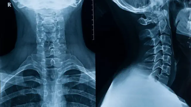 This Recent Breakthrough May Aid in Healing Spinal Cord Injuries