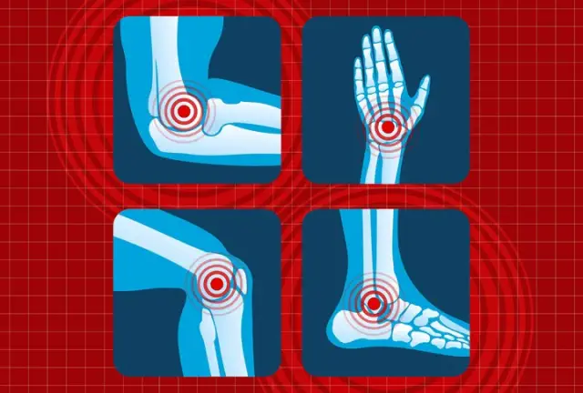 5 Popular Arthritis Misconceptions, Clarified by Research