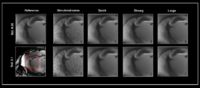 Enhancing noise reduction techniques in structural MRI imaging